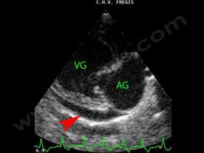 Echographie cardiaque montrant un épanchement péricardique modéré